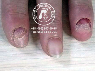 Грибковое заболевание ногтей (онихомикоз). Лечение. Врач подолог Днепропетровск